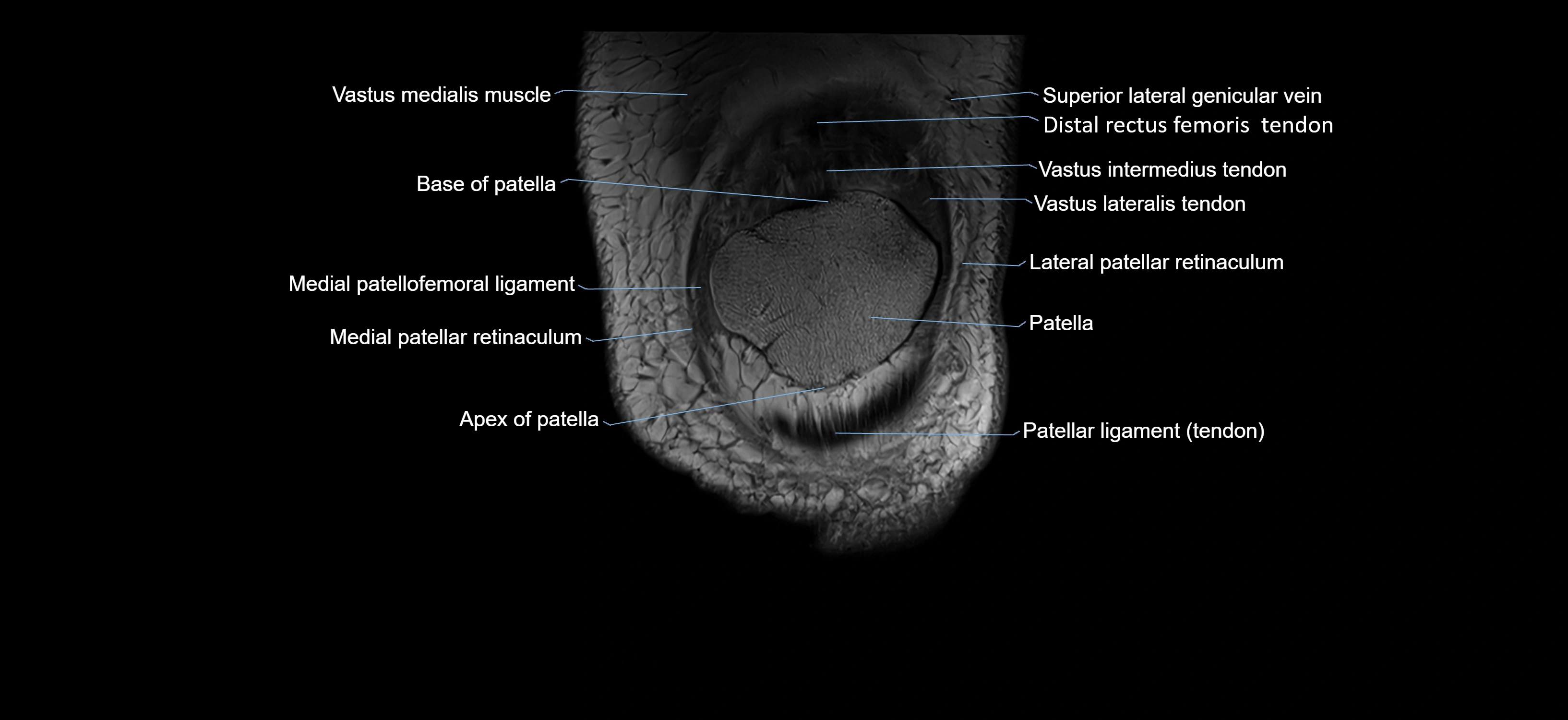 MRI knee coronal cross sectional anatomy labelled 3T radiology  image-04001-00005.webp